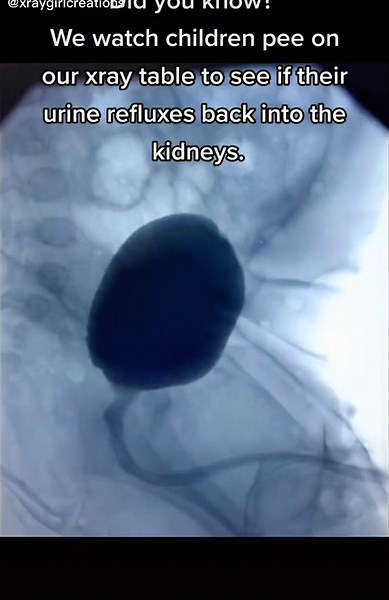 Understanding Hydronephrosis and Infections in Children: X-Ray Insights