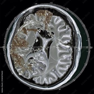 Amyloid plaque brain. Neurodegeneration cells. A high-resolution MRI scan of a human brain showing possible abnormalities or lesions in the left hemisphere. Stock Video