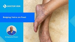 Bulging Veins on Feet - Doctor Vein