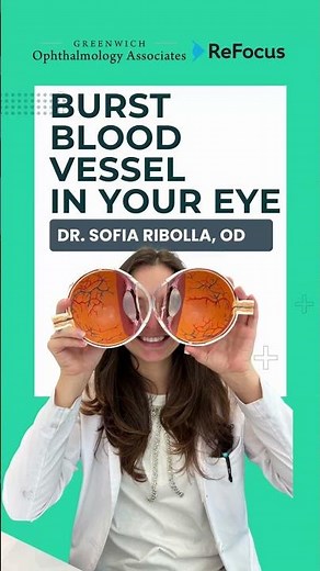 Is Your Eye Bloodshot? What You Need to Know About Subconjunctival Hemorrhage! Shared by CT Eye Dr