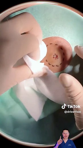 Big cyst removal #pimple #cyst #blackhead #pimplepop #acne #acnetreatment #satisfying #relax #foryou