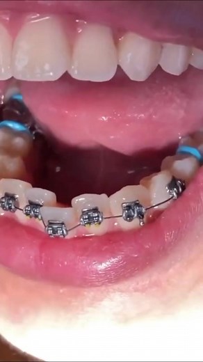Lower arch Braces before & after. #teethstraightening #okara #okaralover💪💪❤️ #hatibdentalclinic #okarains