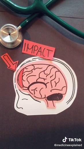 Concussions, explained. #medicineexplained #inyourface #learnontiktok #mentalhealth #familystorytime #india #philippines #malaysia #canada #uk #africa