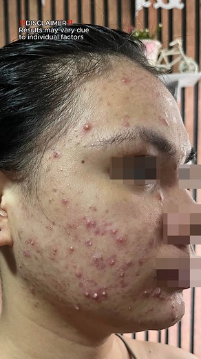 ✨3 months on the DMD Glow Program✨ ✨Clear skin is a journey, not a...