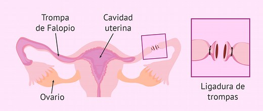 ¿Qué es la ligadura de trompas? - Ventajas y consecuencias