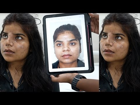 Nose Transformation with Radix Augmentation | Rhinoplasty