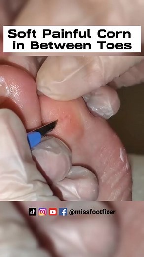 6.4K views · 49 reactions | Soft " Painful " Corn in Between Toes #cornremoval #podiatry #podiatrist #hardskin #podology | Miss Foot Fixer | Facebook