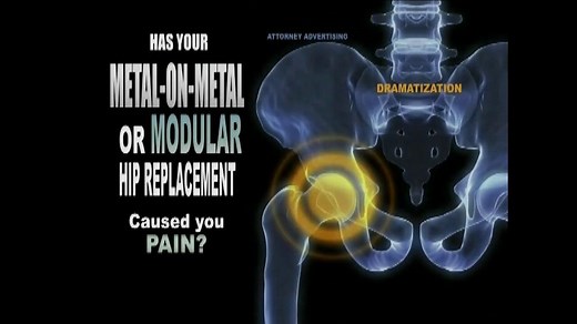 Weitz and Luxenberg TV Spot, 'Metal-on-Metal Hip Replacement'