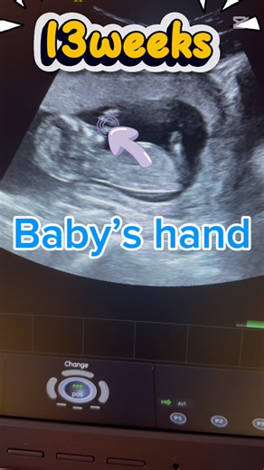 2D Ultrasound for baby 13weeks l Pregnancy ultrasound #ultrasound #pregnancy