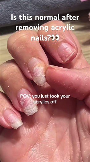 I am annoyed what happen to my nail😩