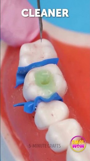 Inside the Cavity Removal! POV from a Dentist 😳🔎 #toothcare