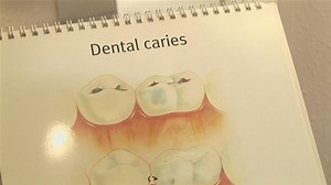 Ways Of Avoiding Tooth Decay