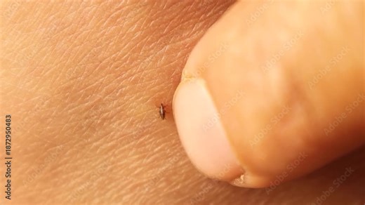 Macro stubborn flea biting human skin and sucking blood, refusing to detach when pushed by a finger. Powerful visual for zoonotic diseases, flea-borne infections, parasitology, dermatology and health.