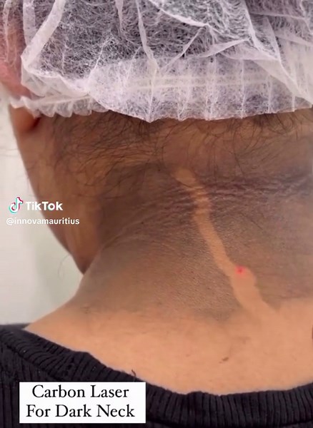 NECK WHITENING 1000Rs‼️🔥🇲🇺SALE Only 1 week🔥🇲🇺💋COMBO FACIALs❤️🔥up to -40-50-60% OFF Use PROMO code “WEEKDAYS”(excluding Public Holidays) & get: ✔️Single facial 1200 Rs instead of 3000 Rs ✔️2 in 1 FACIAL 2000 Rs instead of 4500 Rs ✔️3 in 1 FACIAL 3000 Rs instead of 6000 Rs ✔️4 in 1 FACIAL 3400 Rs instead of 7400 Rs ✔️5 in 1 FACIAL 3800 Rs instead of 8400 Rs Use PROMO code “WEEKENDS” (Saturday/Sunday/Public Holiday) & get: ✔️Single facial 1500 Rs instead of 3000 Rs ✔️2 in 1 FACIAL 2500 Rs i