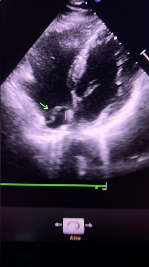 “Echo Pitfall: Chiari Network Mimicking Thrombus in RA”#echocardiography #rightatrium #chiarinetwork