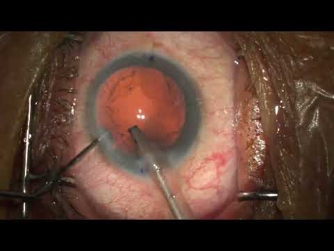 20250916 Phaco IOL 39 (Horizontal chop)