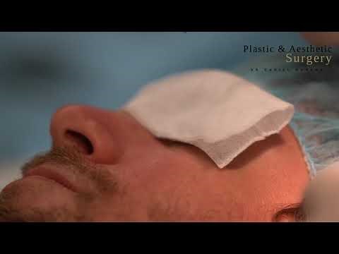 Intradermal nevus removal