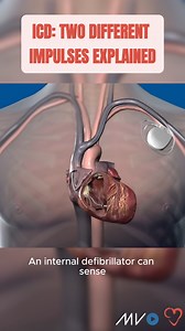 An Implantable Cardioverter Defibrillator (ICD) can send two types of electrical impulses to keep the heart in rhythm. Low-energy pacing delivers small, painless electrical impulses to the heart like a pacemaker or series of impulses (over-drive pacing) to correct certain abnormal fast rhythms (pathological tachycardias). High-energy defibrillation (shock) delivers a strong, brief shock when the heart goes into a life-threatening rhythm such as ventricular fibrillation (VF) or ventricular tachyc