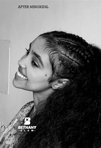 Minoxidil Benefits: Hair Growth and Usage Guide