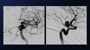 #338: Pterional Craniotomy for Clipping of a Dolichoectatic Thrombotic Fetal Posterior Cerebral Artery Aneurysm  - Aneurysm - Seven Series Collection