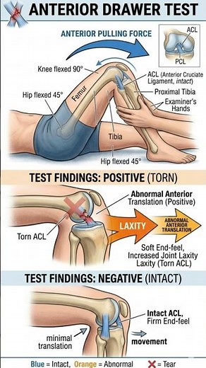 How to Perform the Anterior Drawer Test (Knee Exam)