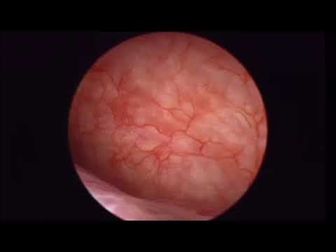 Polype Glandulokystique Hysteroscopie