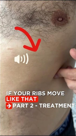 🦴 Slipping Rib Syndrome – Treatment Options | Part 2