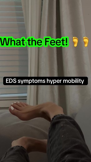 Understanding Ehlers Danlos Syndrome Symptoms in Feet