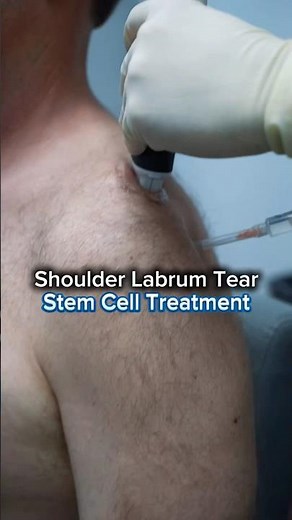 Labrum Tear Stem Cell Injection | Ultrasound Guided Shoulder Treatment
