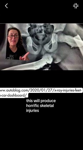 🚗🤦‍♂️Feet On Dashboard: Don't do it. Here's why...#carsafety #dashboard #accident