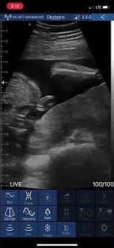 EagleView Wireless Handheld Ultrasound Scanner: Fetal Video