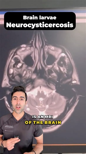 𝐖𝐡𝐚𝐭 𝐈𝐬 𝐂𝐲𝐬𝐭𝐢𝐜𝐞𝐫𝐜𝐨𝐬𝐢𝐬? 🧠🐛 (And Why It’s More Common Than You Think) Cysticercosis is a parasitic infection caused by ingesting the eggs of the pork tapeworm (Taenia solium)—usually through contaminated food, water, or hands. Once inside the body, the eggs hatch into larvae and form cysts in tissues like the brain, muscles, or eyes. 𝐒𝐲𝐦𝐩𝐭𝐨𝐦𝐬 𝐝𝐞𝐩𝐞𝐧𝐝 𝐨𝐧 𝐰𝐡𝐞𝐫𝐞 𝐭𝐡𝐞 𝐜𝐲𝐬𝐭𝐬 𝐠𝐨: 🧠 𝐍𝐞𝐮𝐫𝐨𝐜𝐲𝐬𝐭𝐢𝐜𝐞𝐫𝐜𝐨𝐬𝐢𝐬 — The most dangerous form. Causes s