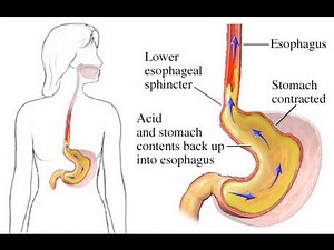 Gastroesophageal Reflux Disease (GERD)