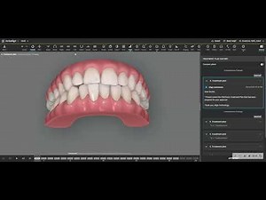 Interproximal Reduction with Invisalign is SAFE if planned properly