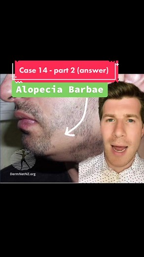 Understanding Alopecia Areata: A Case Study