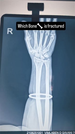 Dr. Paresh Kukadiya | Physiotherapist + Fitness Expert on Instagram: "Hand X-ray challenge 🔍 Spot the fracture if you can comment your answer below 👇 and tag a friend who needs this anatomy quiz fracture diagnosis, hand injury, X-ray interpretation, anatomy learning, physiotherapy, orthopedic cases, medical education, clinical skills #HandFracture #BoneInjury #Physiotherapy #SportsMedicine #RehabJourney #PainRelief #FractureRecovery #HandPain #WristPain #DrPareshKukadiya #PhysioCare #BoneHealt