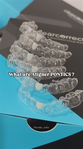 Dr. Niha Naveed | Orthodontist | Aligner pontics are tooth-colored resin or composite materials placed inside clear aligners to fill the space of a missing tooth. They’re... | Instagram