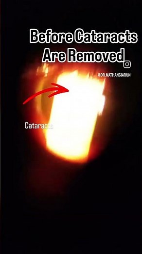 before and after cataract surgery