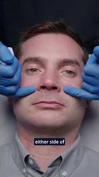 Revolutionary Piriform Fossa Technique for Nasolabial Line Filler! 💉