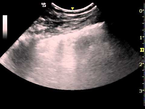 Ultrasonography of canine pulmonary oedema