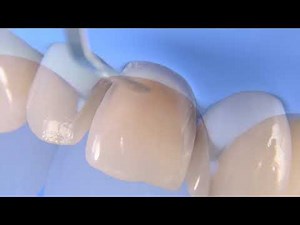 Direct Partial Composite Veneer • Video • MEDtube.net