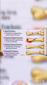 Types of Bone Fractures Explained in 30 Seconds | Medical Short