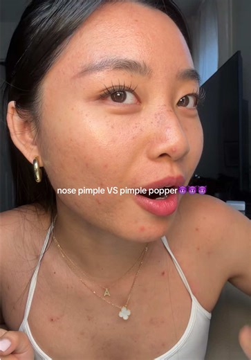 nose pimples take legit weeks to get rid of bruh. #acneproneskin #acneskincare #acnejourney #pimples