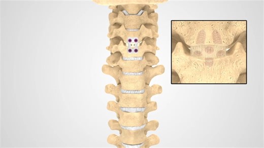 ACDF - Patient Animation