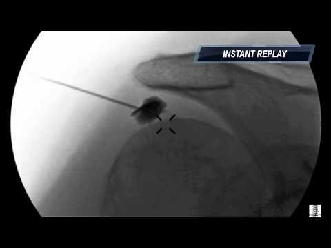 Subacromial Injection under Fluoroscopy - ThePainSource.com