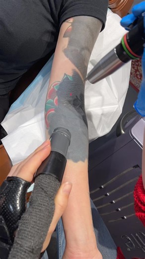 Blackout Tattoo Removal: Before and After Laser Treatment
