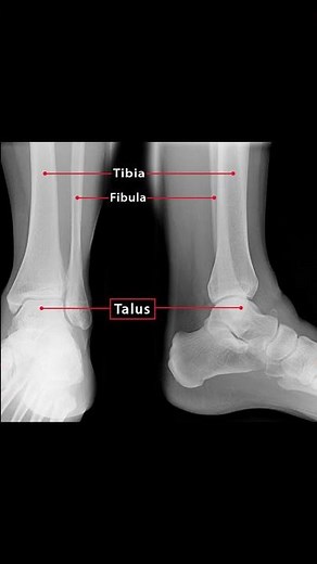 🦴 Understanding the Talus Bone | Key to Ankle Stability! #anatomy #physiotherapy #ATC #podiatry