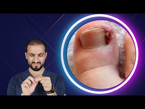آلام في الظفر - الظفر الغائر
