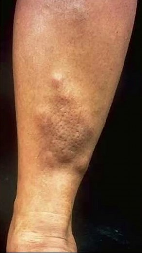 Pretibial myxedema ( localized thickening on shins ). Lesions are asymptomatic . Cosmetic concerns.