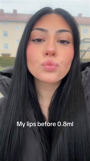 Stunning Lip Transformation: Before and After Fillers
